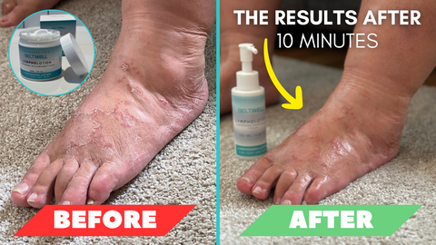Beltwell® - The Ultra-Soft Lymphedema Lotion For Dry Skin
