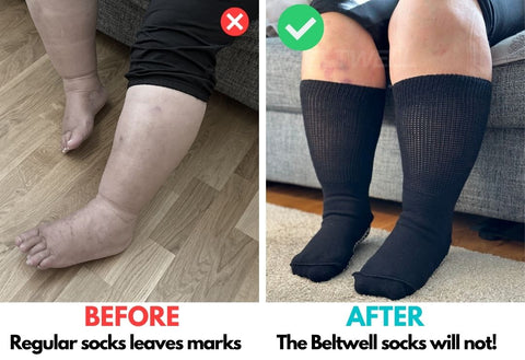 Beltwell® - The Oversized Socks For Big Swollen Legs & Feet (2 pairs)