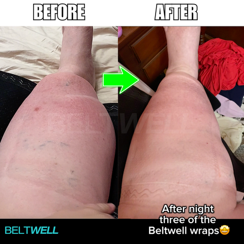 Beltwell® LymphoTech™ - The NEW Advanced Lymphatic Compression Technology for Big, Swollen Calves (1 wrap)